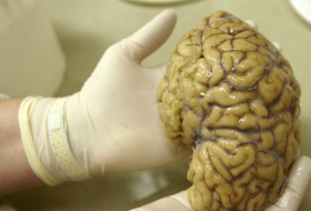 Un misterioso trastorno cerebral desconcierta a los médicos canadienses