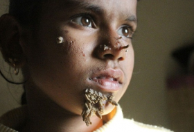 Niña de Bangladesh tiene síndrome del ‘hombre-árbol’