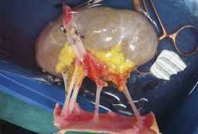  FOTO:  Doctores hallan una anomalía extremadamente rara en un riñón mientras se preparaban para trasplantarlo a una niña