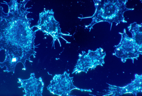 Identifican una nueva forma de combatir el cáncer resistente a la quimioterapia