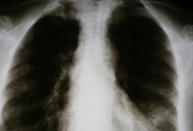 Google enseña a la IA a diagnosticar condiciones pulmonares con la precisión de un especialista humano