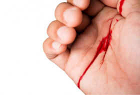   Hemofobia  : ¿Por qué ver sangre provoca desmayo a algunas personas?