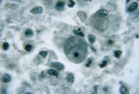 Confirman un caso de infección por una ameba que destruye el cerebro en Florida