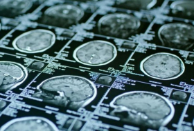 Por qué los científicos creen que el COVID-19 causa pérdida del tejido cerebral a largo plazo